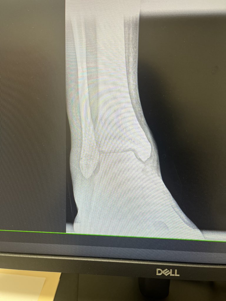 Mintzy: Weber A Fracture below the ankle. Stable no surgery but did look displaced on 1 of the 3 X Rays.

Gotta watch it close n